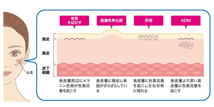 シミの種類と発生箇所