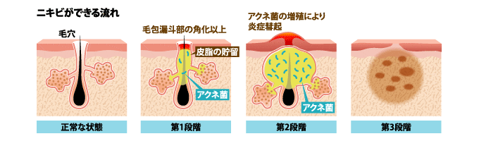 ニキビができる流れ