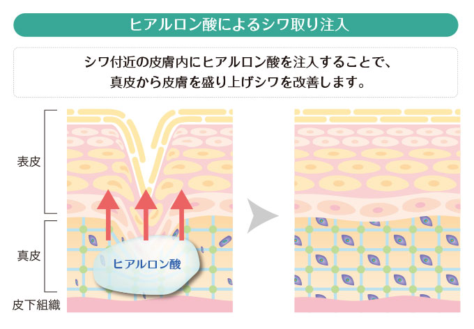 ヒアルロン酸によるシワ取り注入