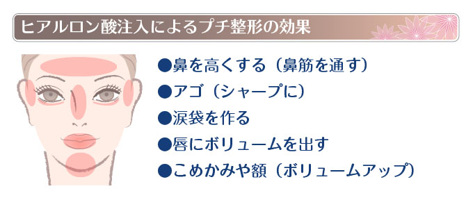 ヒアルロン酸注入によるプチ整形の効果