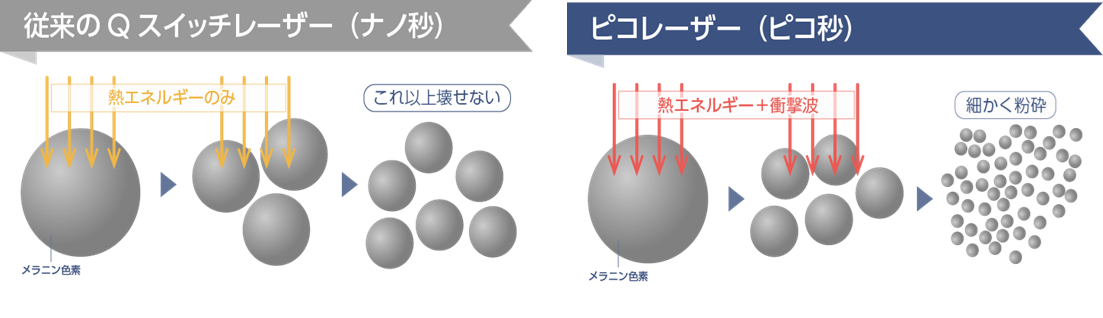 レーザー比較表