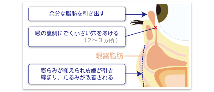 経結膜下脱脂法