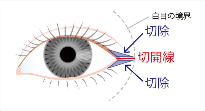 目尻切開法