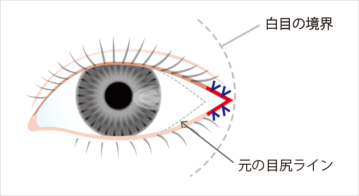 目尻切開法の適応