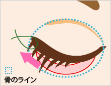 下眼瞼除皺術（筋皮弁法）