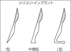 プロテーゼ挿入法術