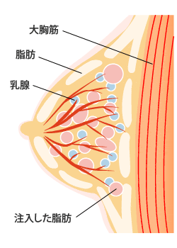 脂肪注入術