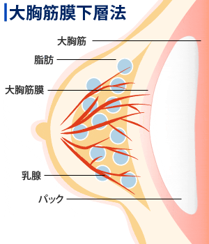 大胸筋膜下層法
