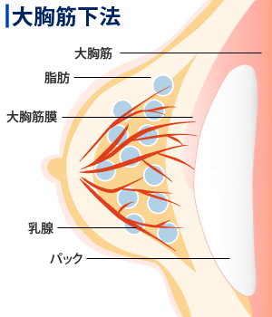 大胸筋下法