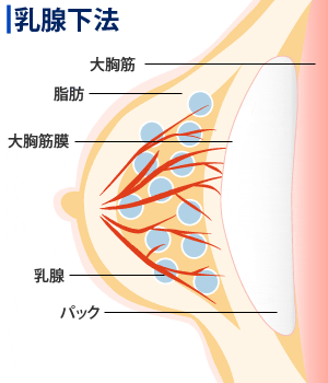 乳腺下法