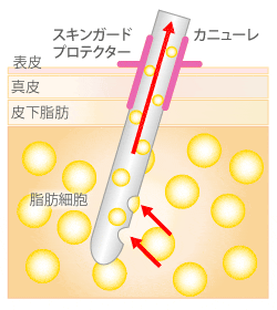 脂肪吸引