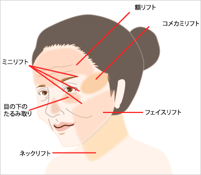 フェイスリフト イメージ