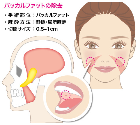 バッカルファットの除去