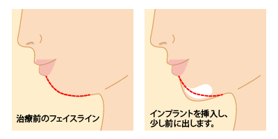 プロテーゼ挿入法施術イメージ