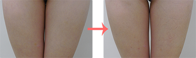 脂肪溶解注射（メソセラピー） 症例写真