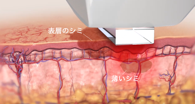 薄いシミや皮膚表層のシミも改善