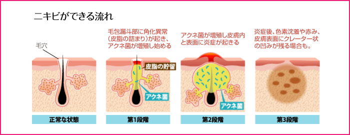 ニキビができる流れ