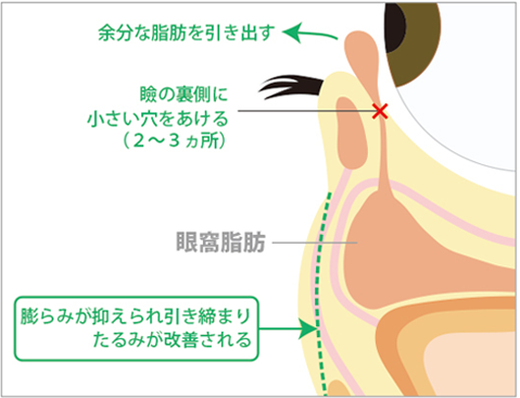 経結膜下脱脂法 イメージ