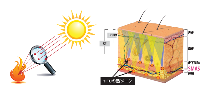 HIFU イメージ