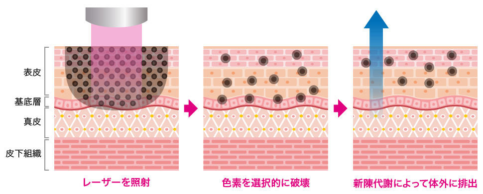 レーザーの衝撃による色素の粉砕・排除 イメージ