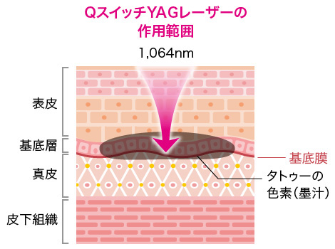 旧型のQスイッチYAGレーザーの作用範囲 イメージ