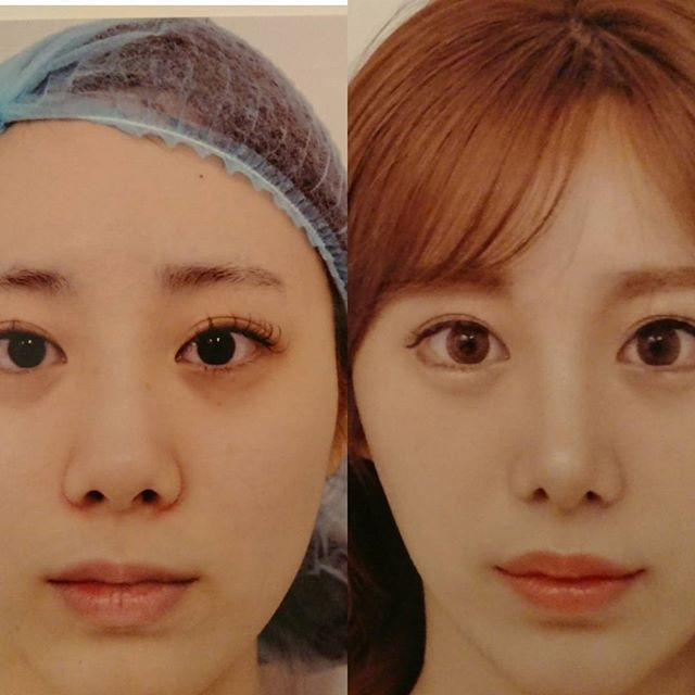 シュッと整えてスマートな顔立ちに 鼻尖縮小で顔面偏差値を高めよう 銀座美容外科クリニック Ginbi Drブログ シュッと整えてスマートな顔立ちに 鼻尖縮小で顔面偏差値を高めよう 銀座美容外科クリニック Ginbi Drブログ