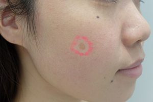 早めの光老化対策を シミ美活 美白特集プランご紹介 名倉直彌 Drブログ Produced By 銀座美容外科クリニック