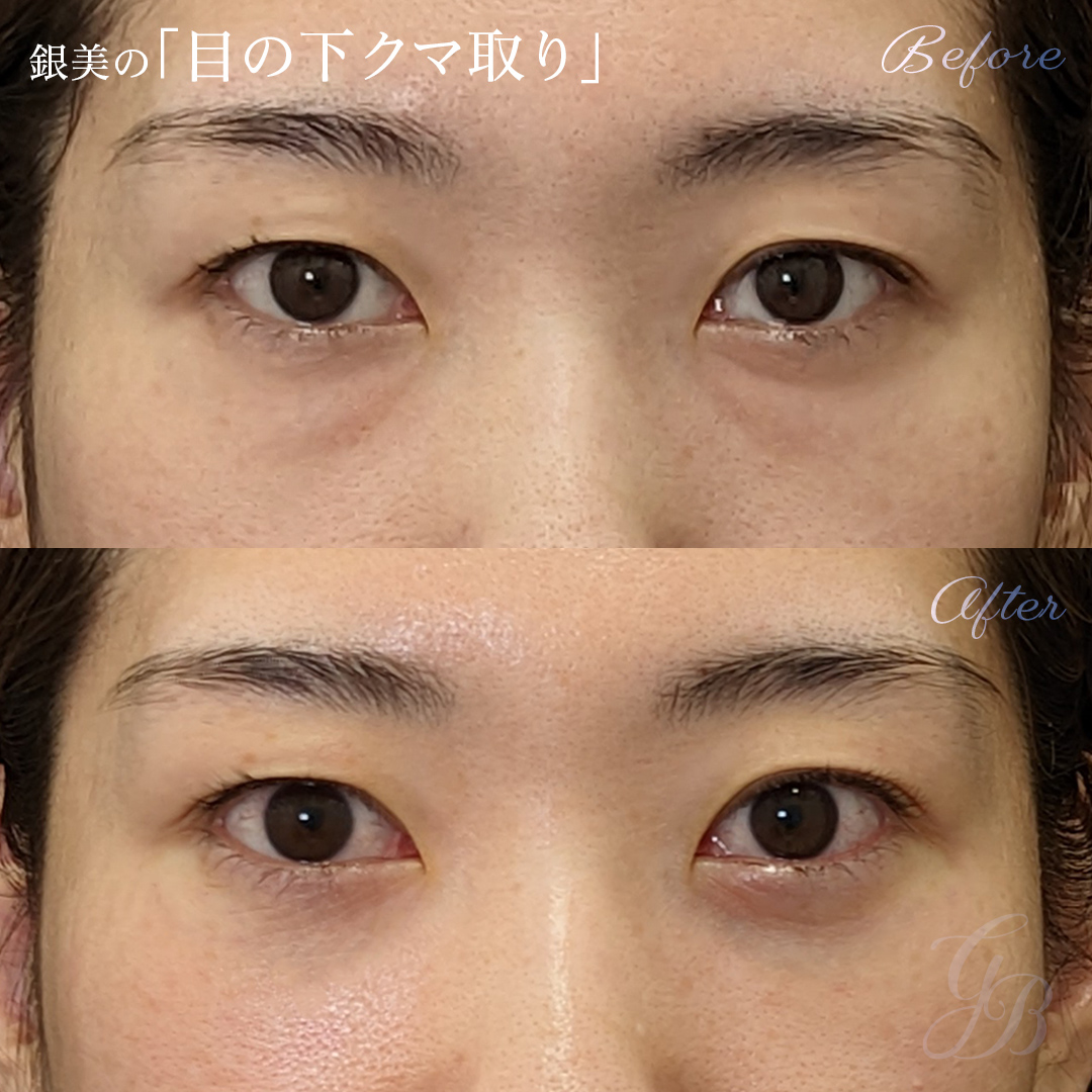 脱脂（目の下のクマ・たるみ取り）症例写真・ビフォーアフター