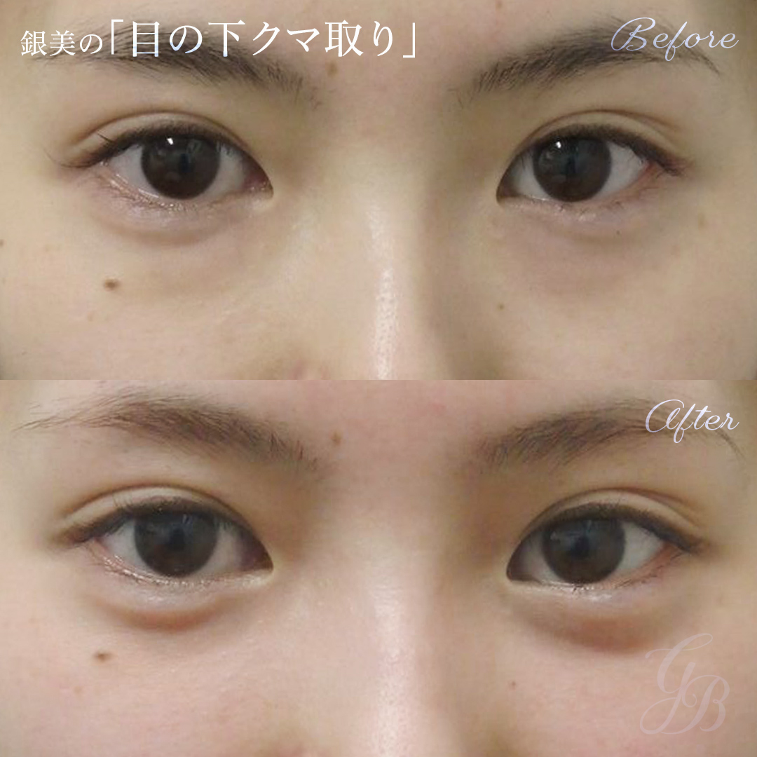 脱脂（目の下のクマ・たるみ取り）症例写真・ビフォーアフター